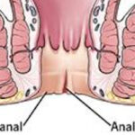 tratament fisuri anale cluj anastasios